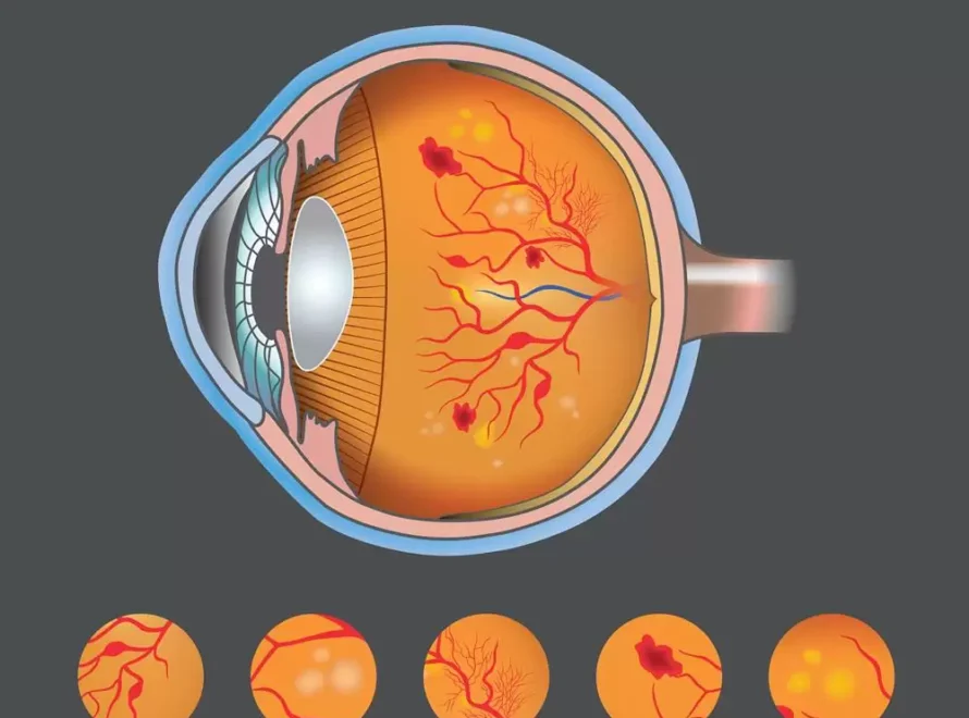 diyabetik-retinopati (1)