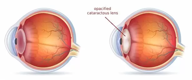 opacified-cataractous-lens