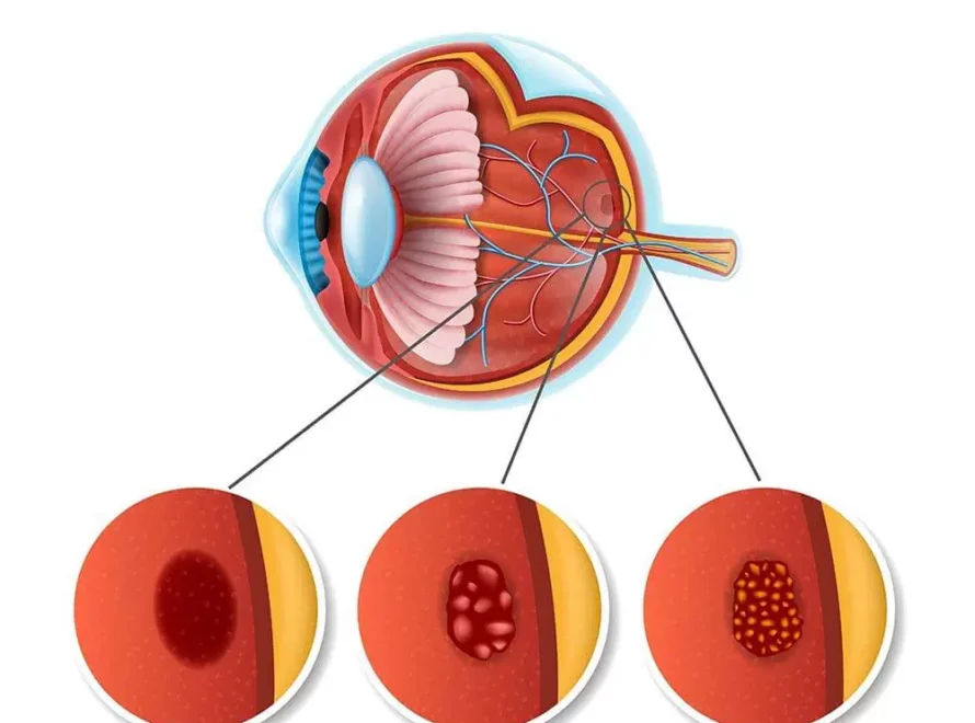 sari-nokta-hastaligi-2