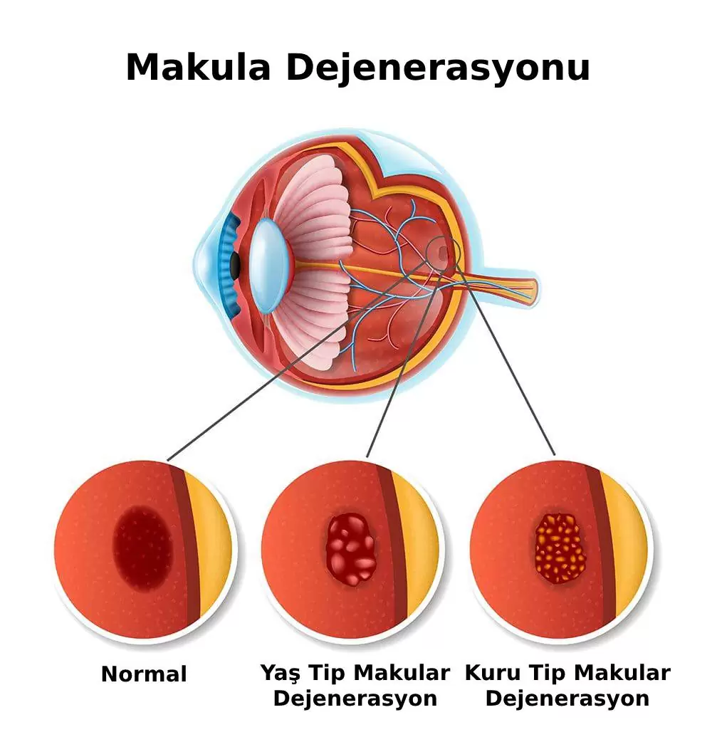 sari-nokta-hastaligi-2