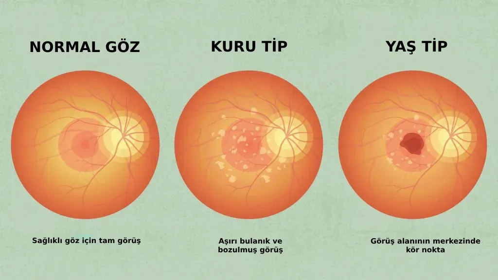sari-nokta-hastaligi